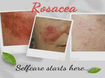Organic Moisturizer for Rosacea Prone Skin