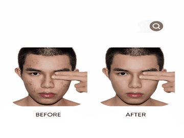 Anti-Acne Organic Facial Wash